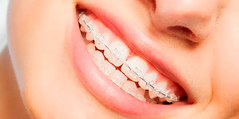 Aparelhos ortodonticos C