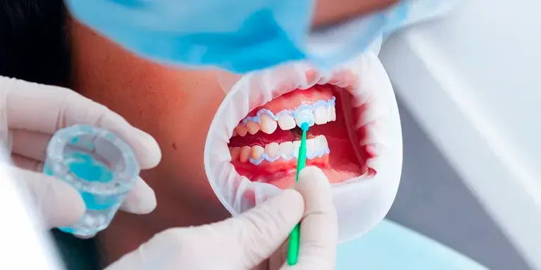 Clareamento dental C